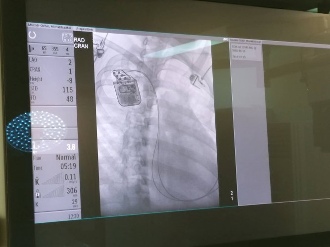 Зүрхний агшилтыг дэмжигч төхөөрөмж буюу Cardiac Contractility Modulation